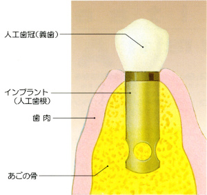 奥野歯科のインプラント1